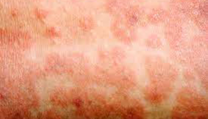 Blotchy skin rash caused by measles.